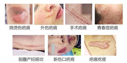 七大常见疤痕