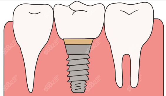 深圳口碑好的种植牙医院推荐www.8682.cc