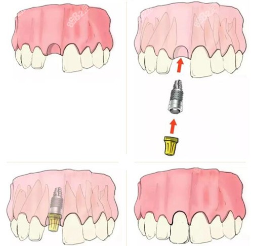 咸宁即刻种植牙费用标准www.8682.cc
