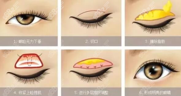 双眼皮做得怎么样
