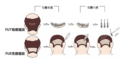 有痕与无痕植发的区别