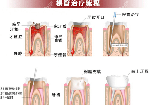 根管治疗