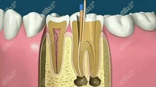 根管治疗