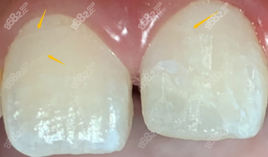 大门牙磕了有横裂纹会断吗？