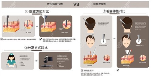 <!--<i data=20240705-sp></i>-->植发医院3D植发技术