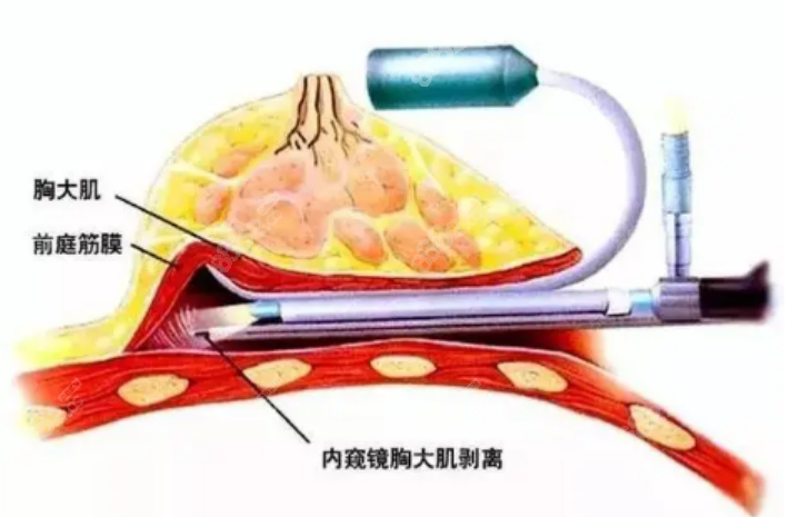 假体隆胸一年后能摸到硅胶特别明显怎么办？