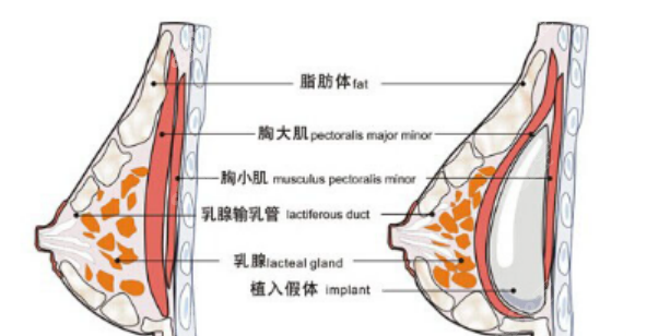 假体隆胸