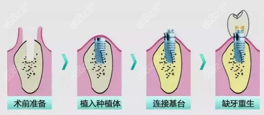 即刻修复和即刻负重一样吗www.8682.cc