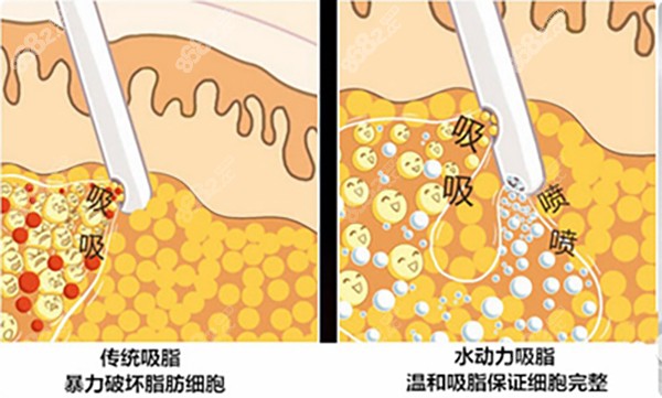 郭金冉水动力吸脂柔和均匀、皮肤平整