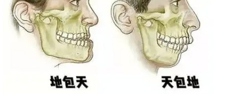 双颚畸形照片