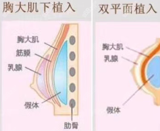 湖州恒颜美<!--<i data=20240705-sp></i>-->假体隆胸技术优势