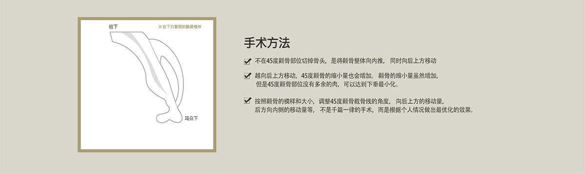 韩国菲斯莱茵颧骨整形技术