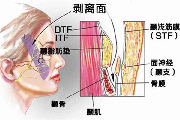 冯立哲多维拉面部提升能维持多久