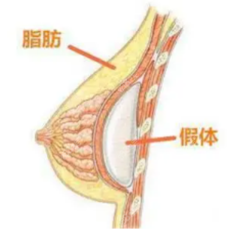 深圳南雅缩胸手术