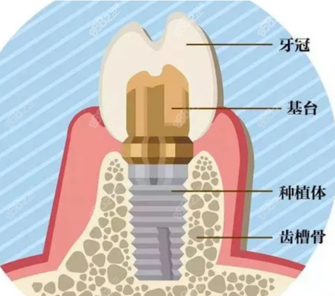 上海清木口腔医院种植牙