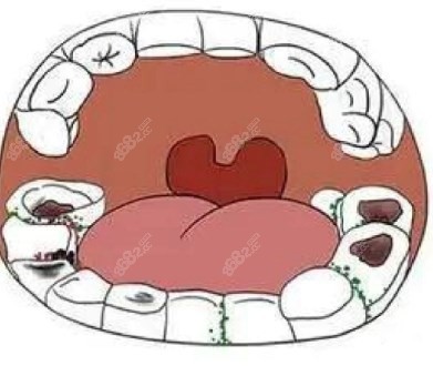 牙齿龋坏