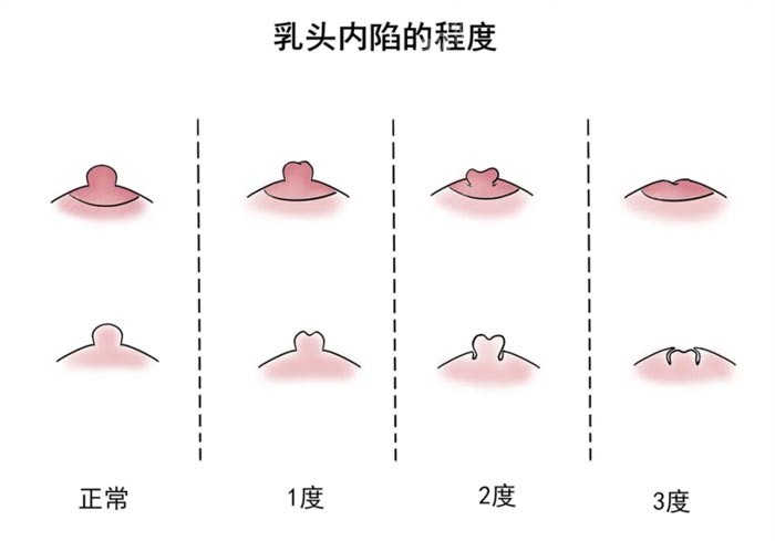 韩国md整形乳头内陷矫正多少钱和内陷程度有关