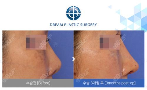 韩国梦想整形外科医院鼻修复对比