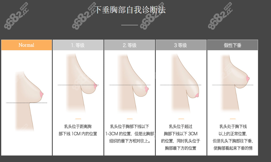 韩国wune医院胸下垂矫正怎么样