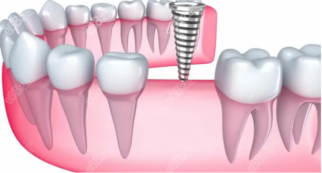 上海清木口腔医院种植牙