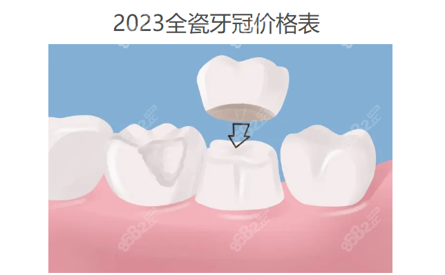 2023全瓷牙牙冠价格表www.8682.cc