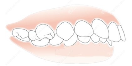 牙齿矫正不受年龄限制