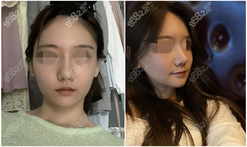 韩国GNG医院鼻修复对比