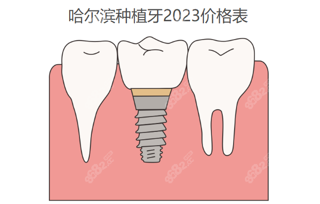 哈尔滨种植牙2023价格表