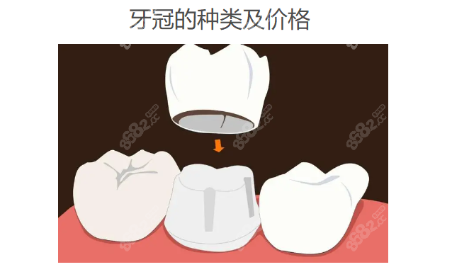 牙冠的种类及价格