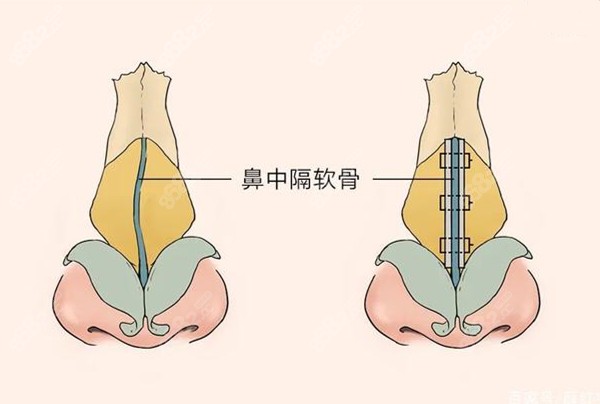 韩国歪鼻矫正价格表