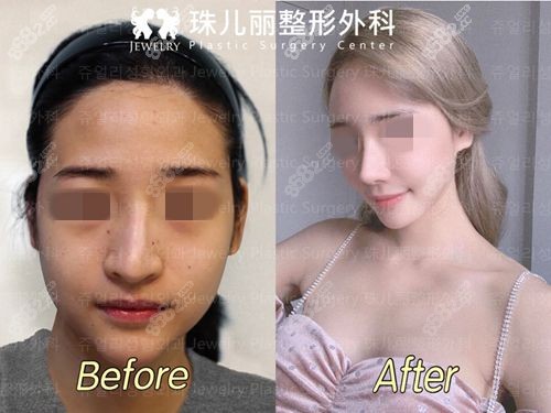 韩国珠儿丽整形外科鼻修复对比