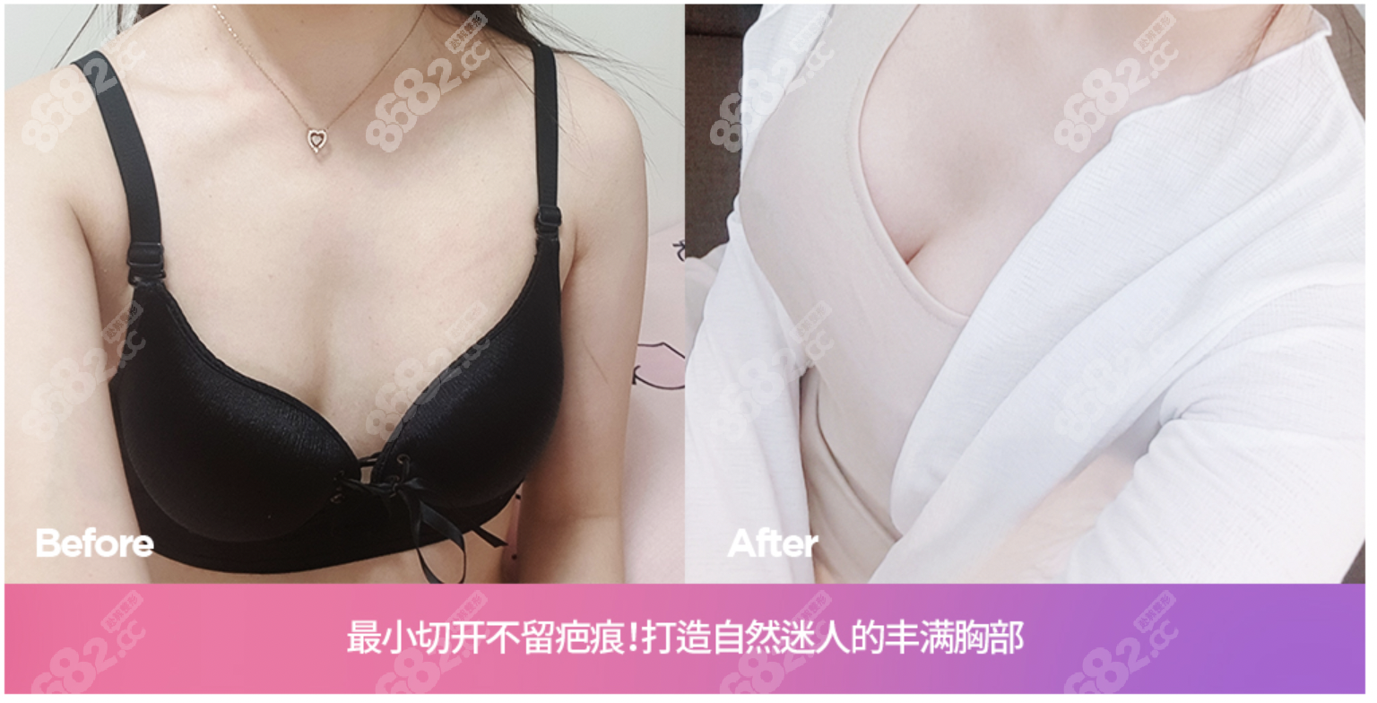 赵承佑魔滴假体隆胸实例