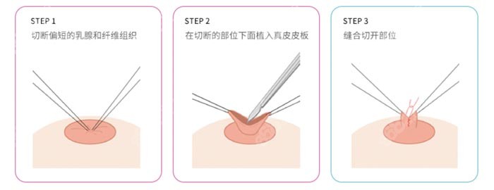 韩国MD整形做乳头内陷的手术原理www.8682.cc