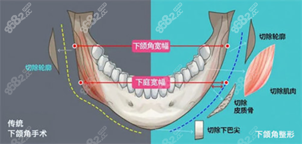 下颌角整形
