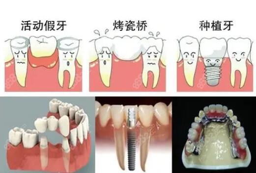 镶牙的几种方式对比