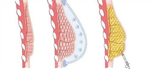 玻尿酸丰胸对比图