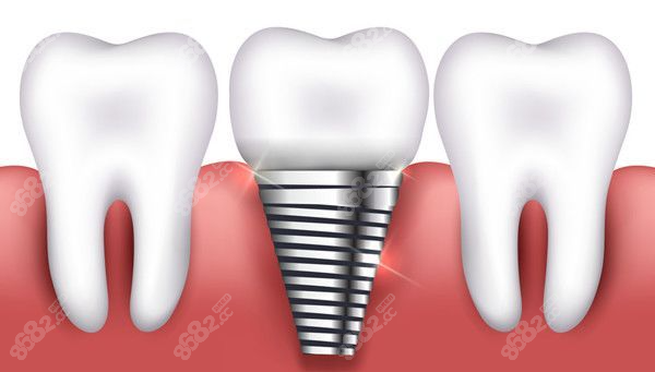 上海普陀区种植牙价格多少钱m.8682.cc