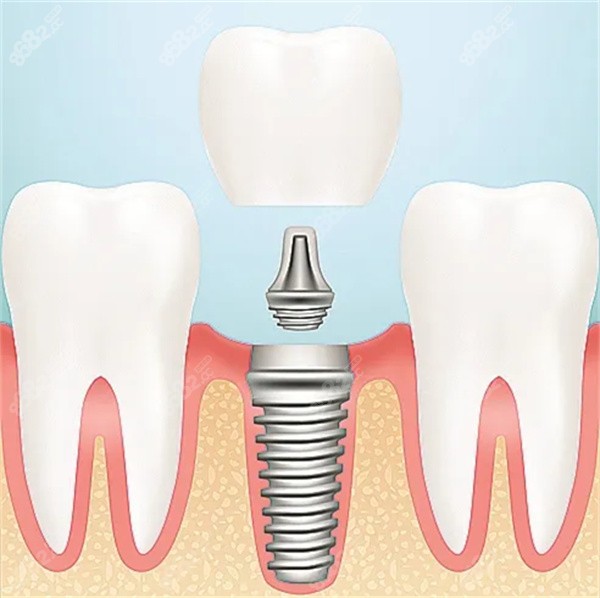 长春拜博口腔种植牙价格表8682.cc