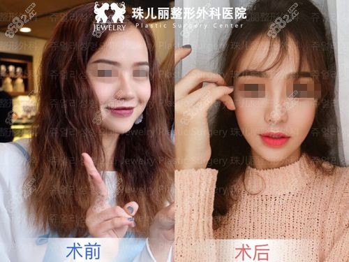 韩国珠儿丽整形外科方下颌缩小术对比照