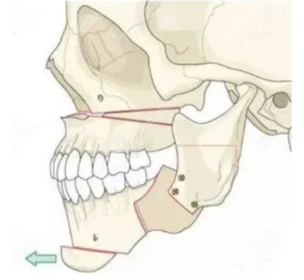 正颌手术