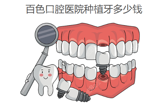 百色口腔医院种植牙多少钱