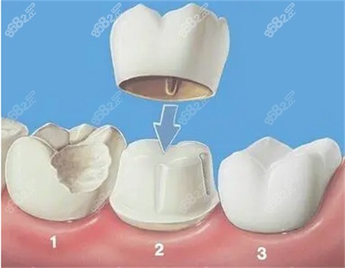 牙齿修复图