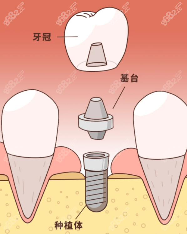 种植牙