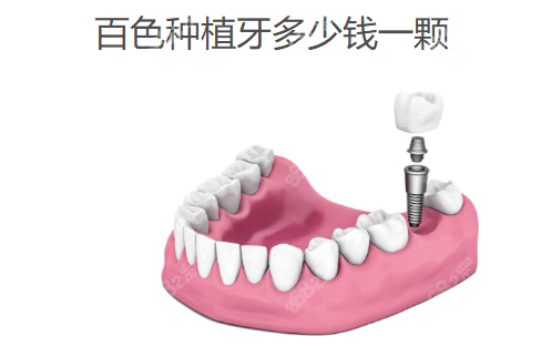 百色种植牙多少钱一颗