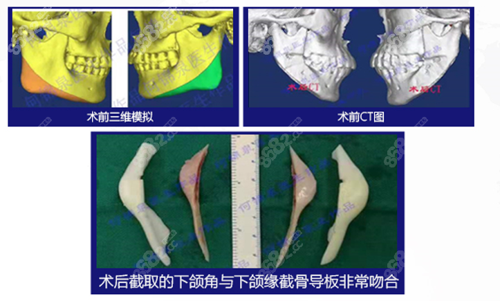 羅延平改臉型技術(shù)好