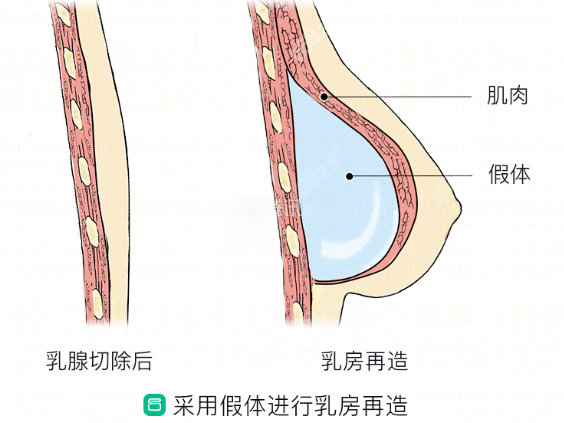 乳房再造手术图示8682.cc