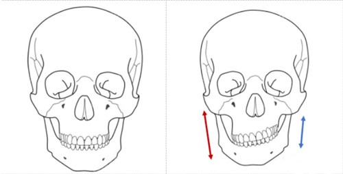 正常颌面跟颌面畸形对比