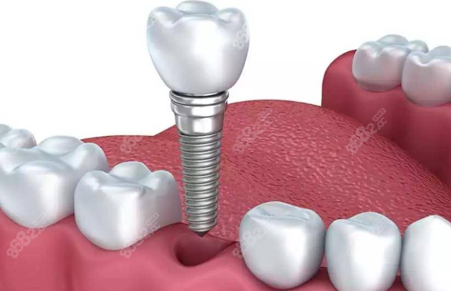 上海天佑口腔种植牙价格不贵