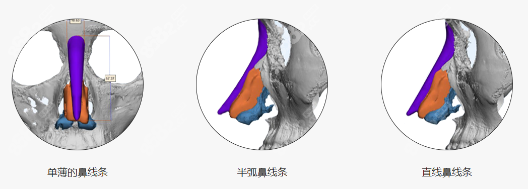 韩国鲁峰一做3d打印隆鼻技术好在可以定制喜欢的隆鼻风格