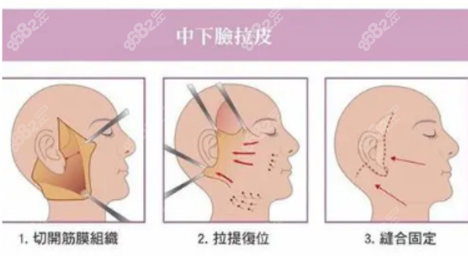 黄广香医生拉皮